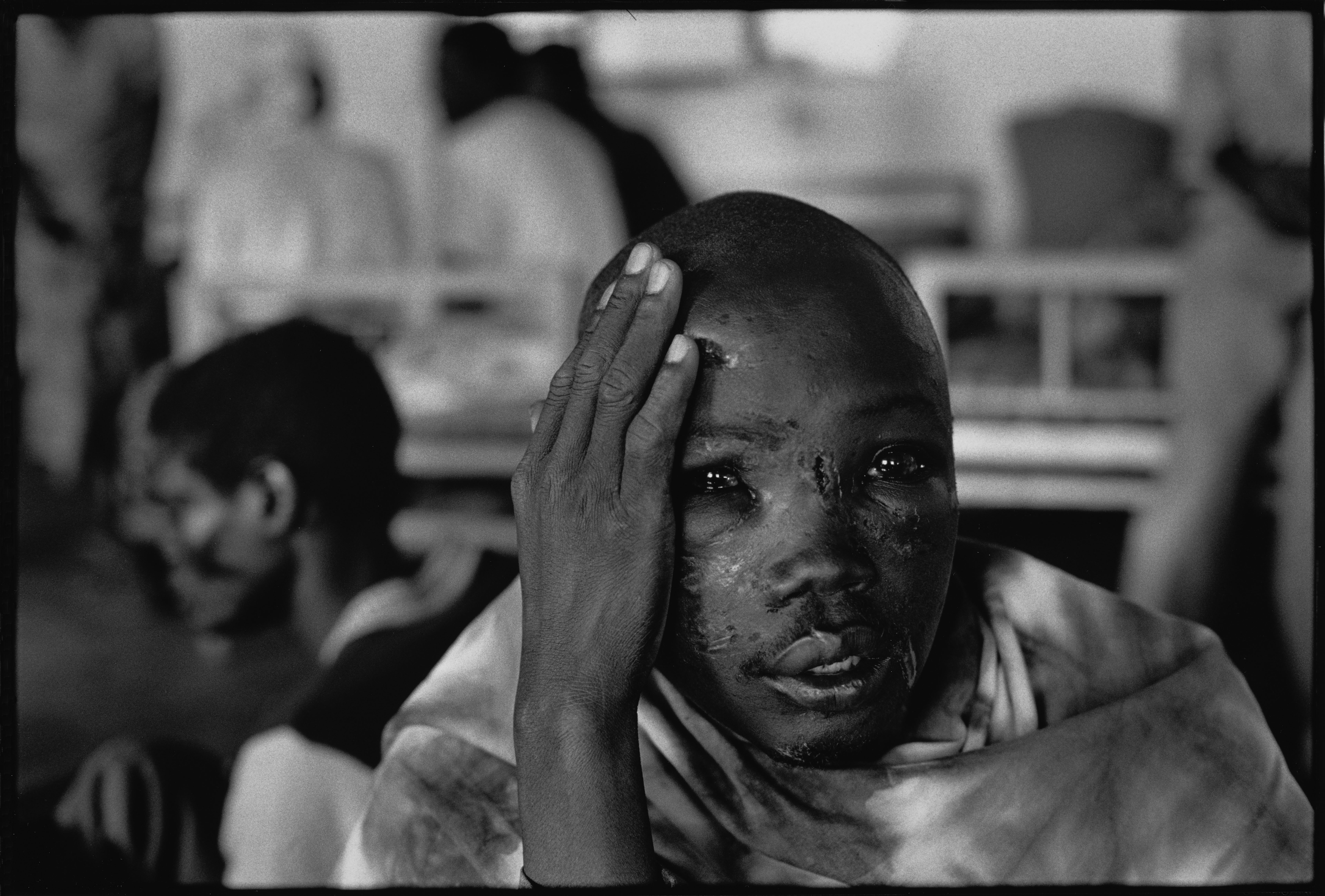 在卡布加伊（Kabgayi）一處營地附近的醫院，一名面部受重傷的男子看著鏡頭。盧安達，1994年。